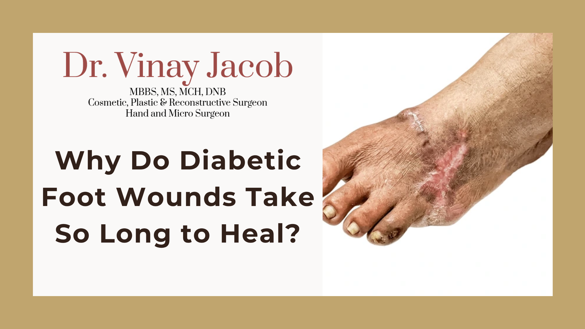 Why Do Diabetic Foot Wounds Take So Long to Heal?